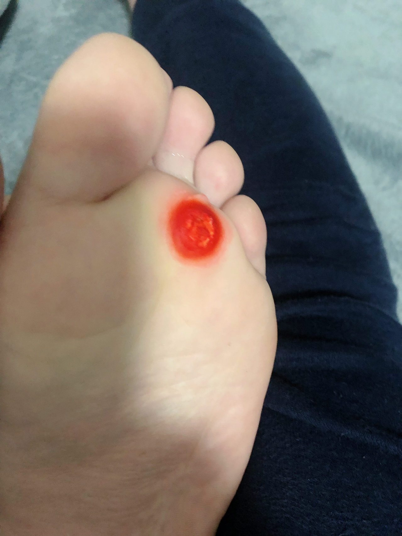 脚底长鸡眼痛苦不堪的治疗过程