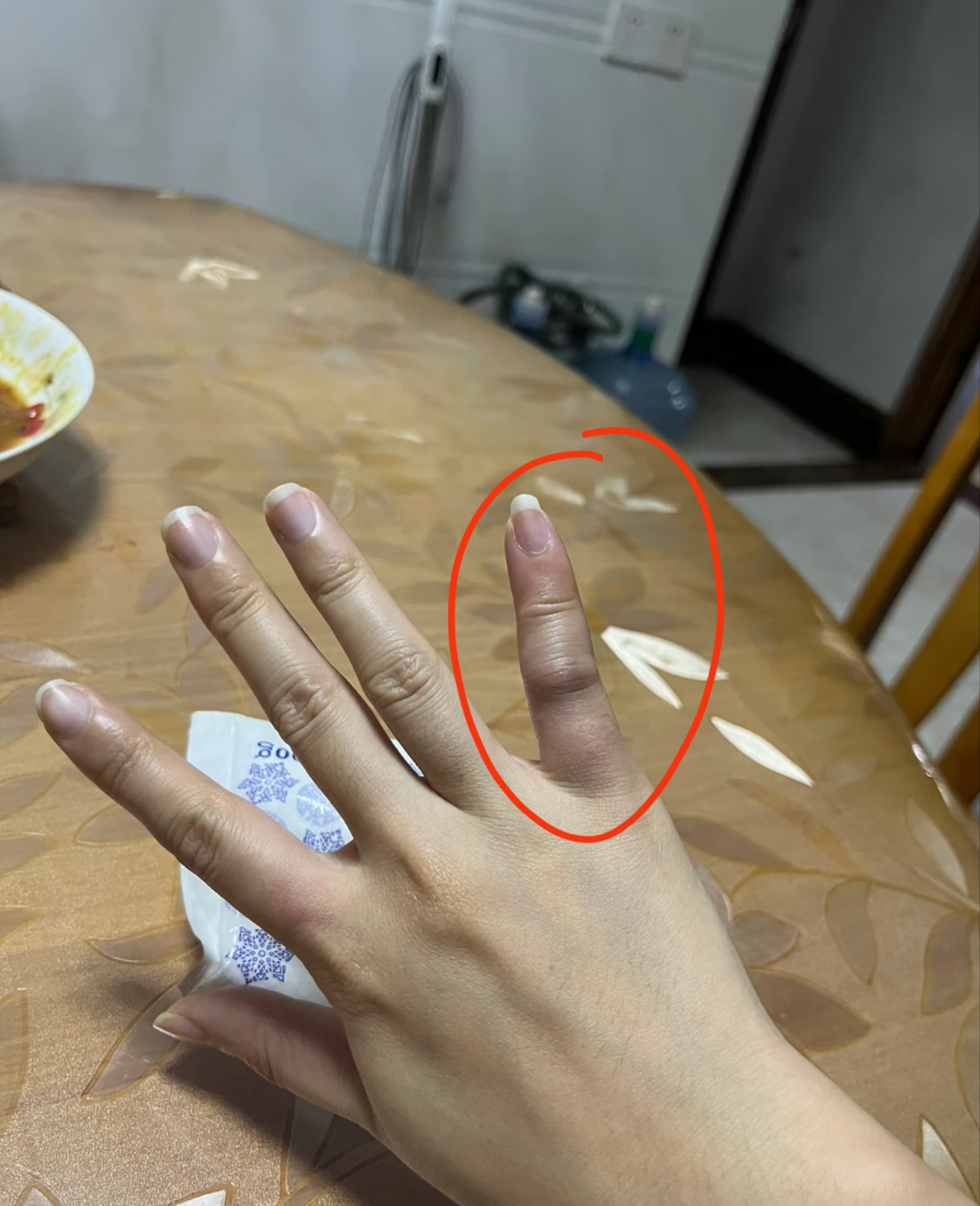 手指关节凸起并疼痛,可能由外伤,滑膜炎或骨质增生引起