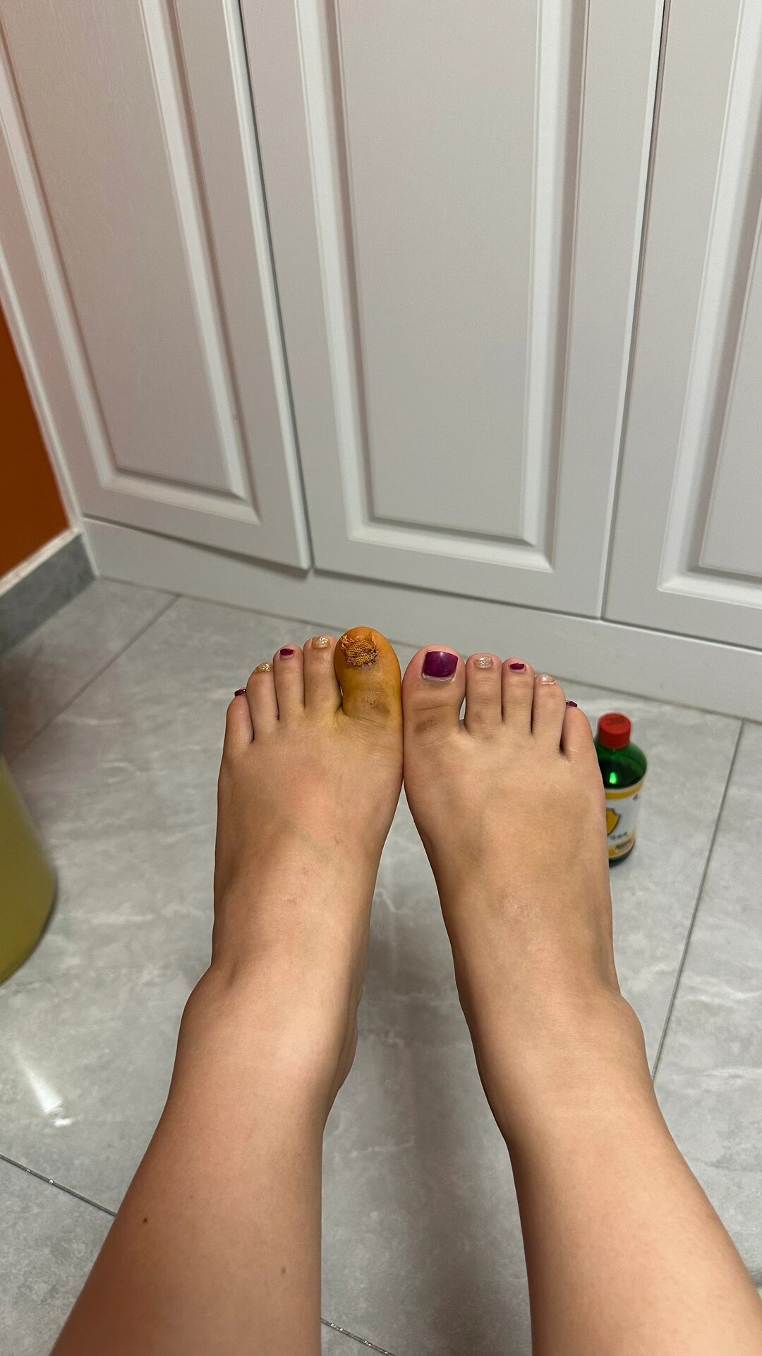 当时已经没有痛感,赶紧打电话找家人去了急诊,当