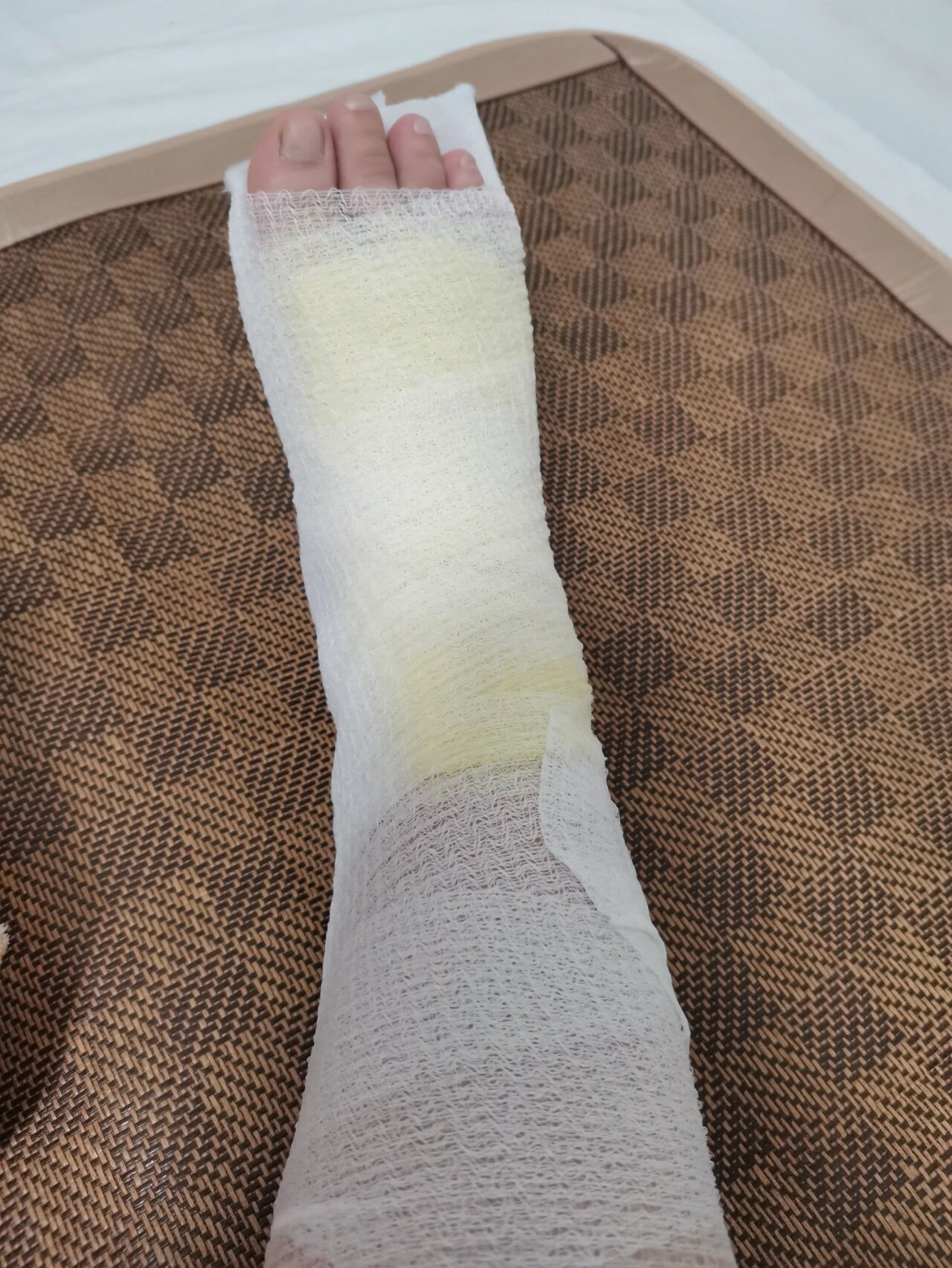 片子,骨折情况和上周没什么变化,但是已经消肿很多啦,绷带都松了不少