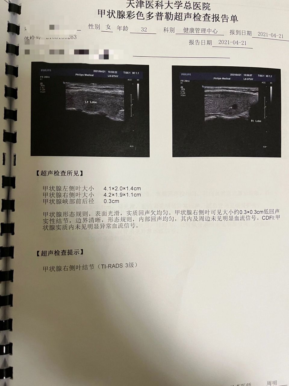甲状腺结节3级,怎么判断?