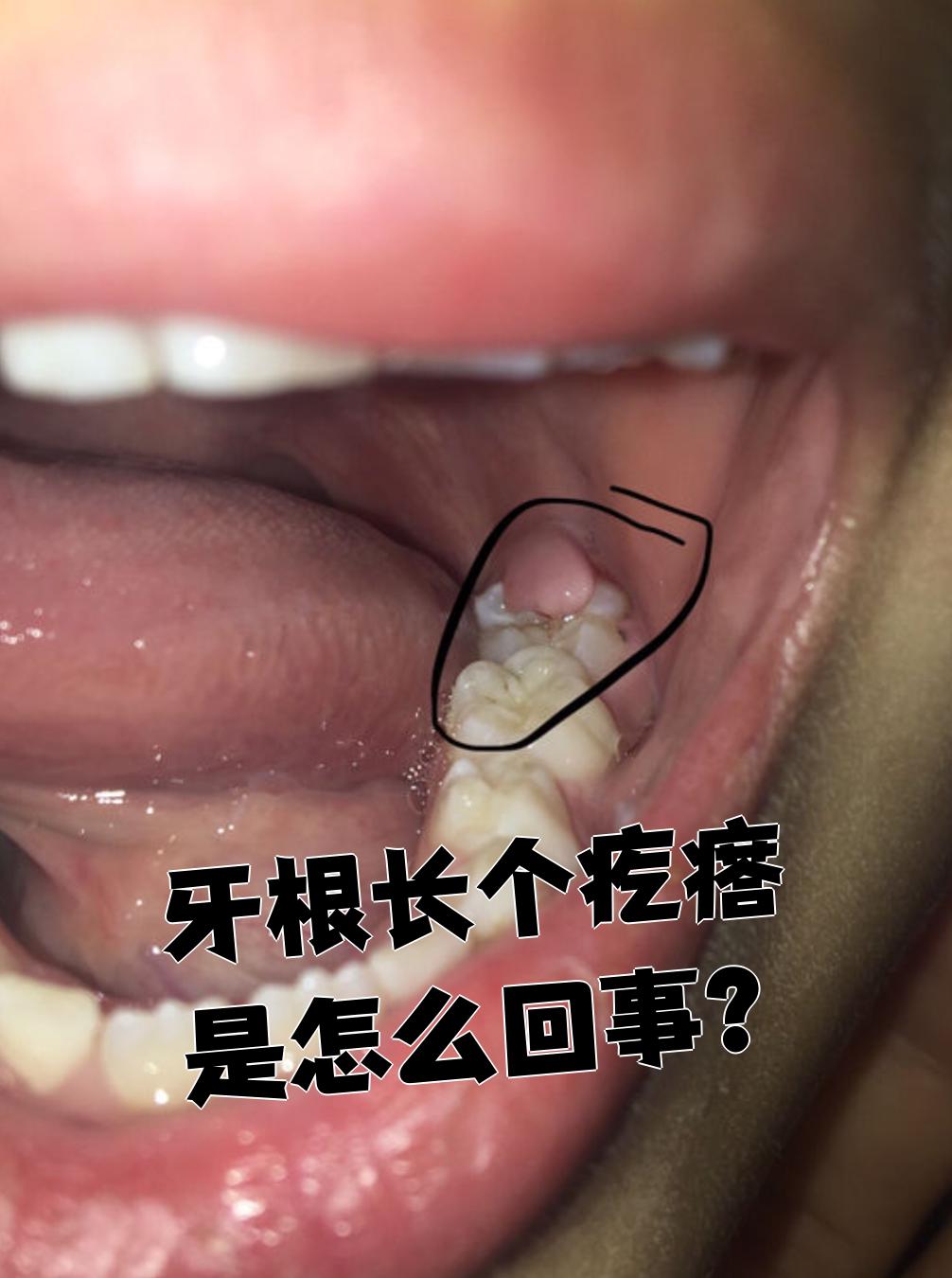 牙根长个疙瘩是怎么回事?
