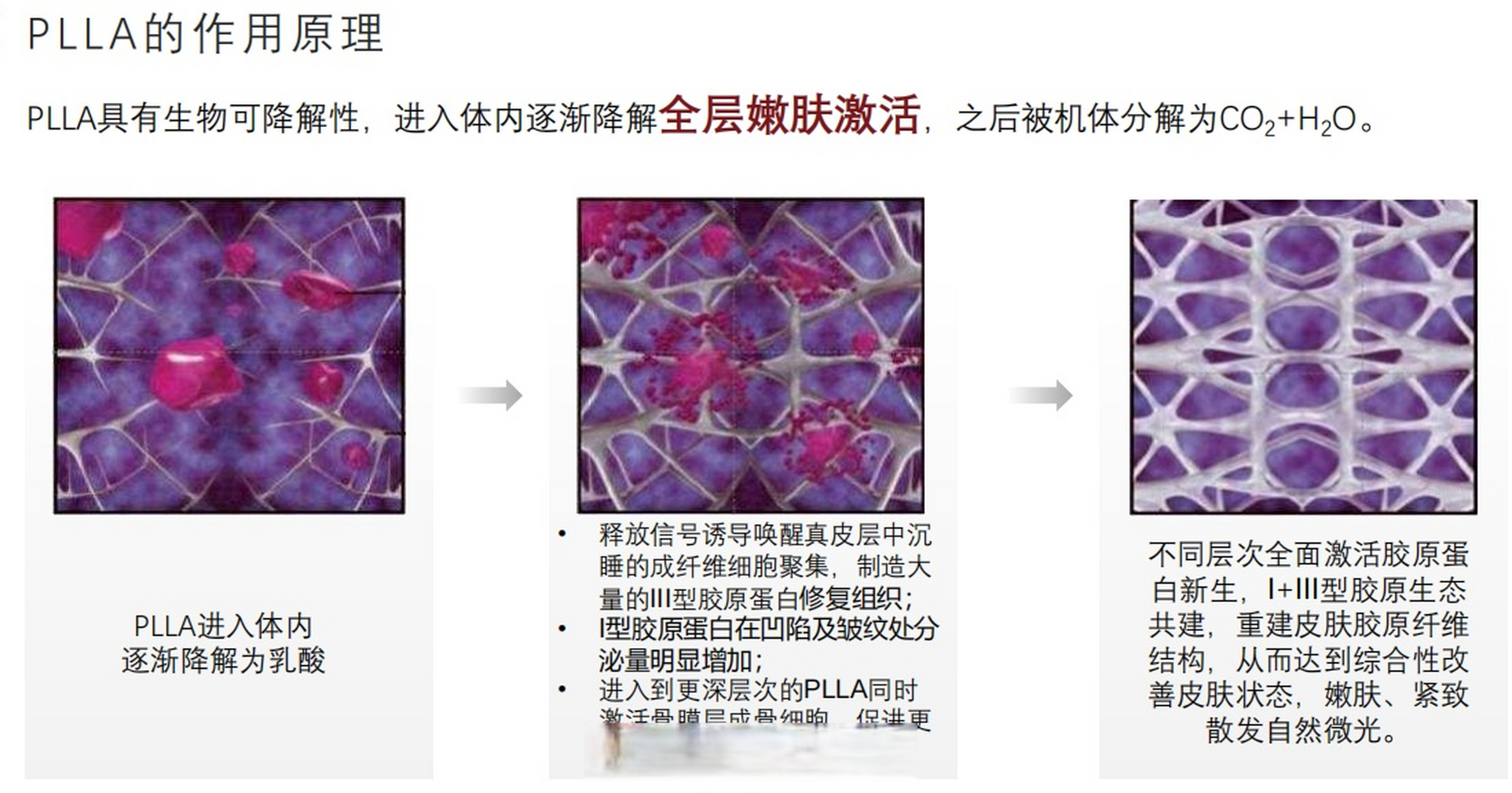 童颜针# #plla# 聚左旋乳酸(plla)是如何发挥作用的?