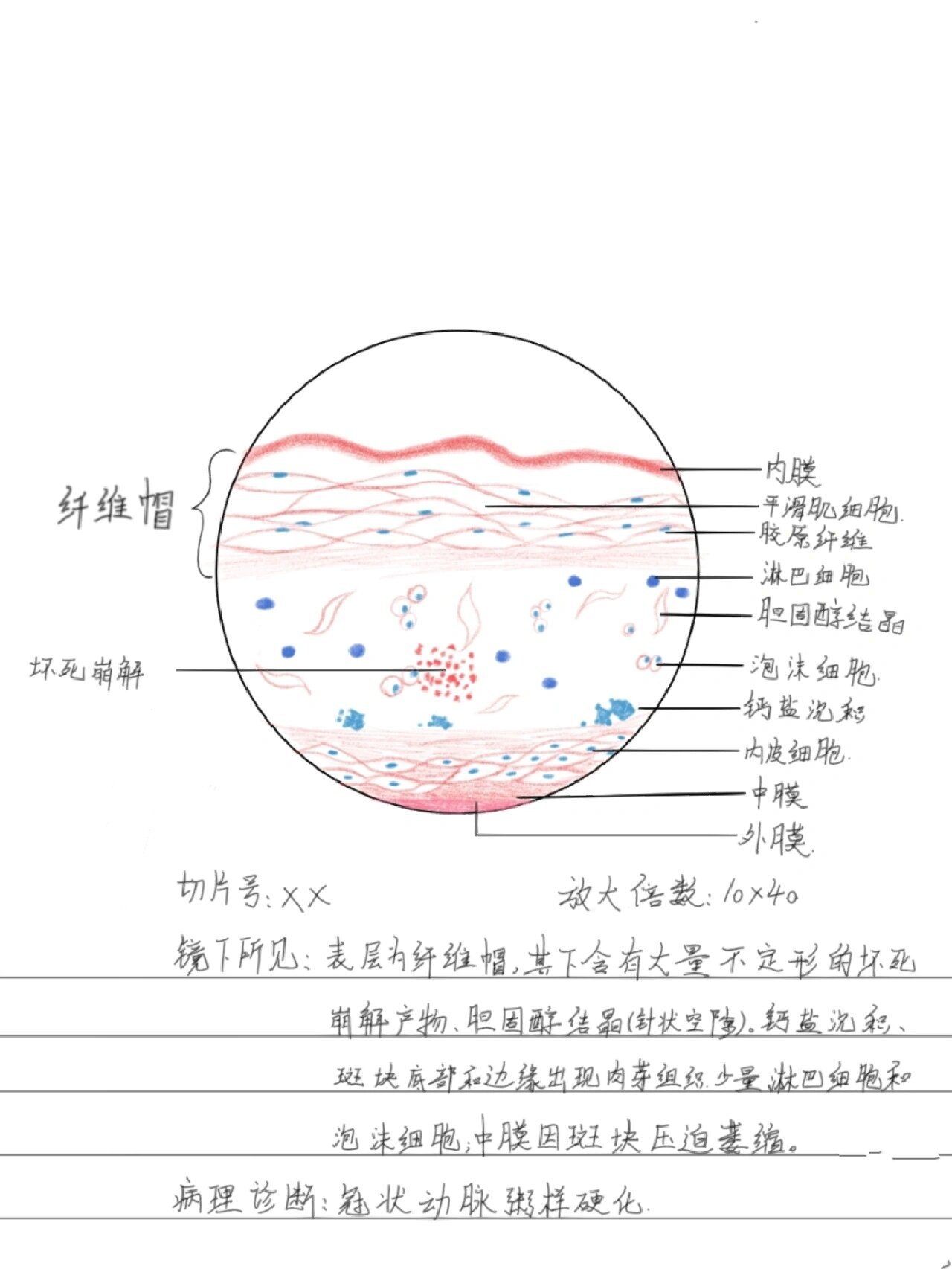 葡萄胎切片绘图图片