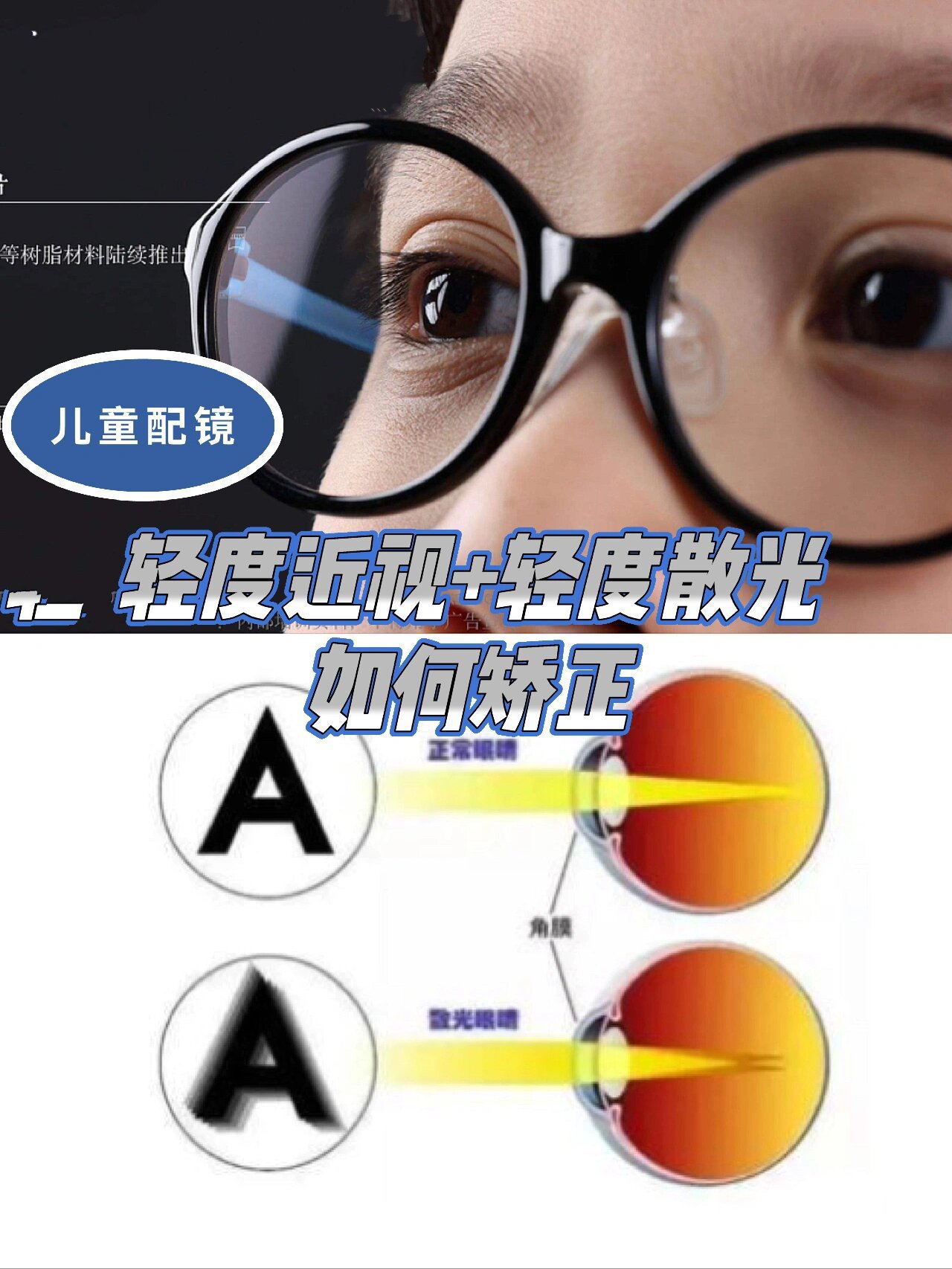 轻度近视77轻度散光是否需要矫正 当孩子没有调节问题,眼位正的时候