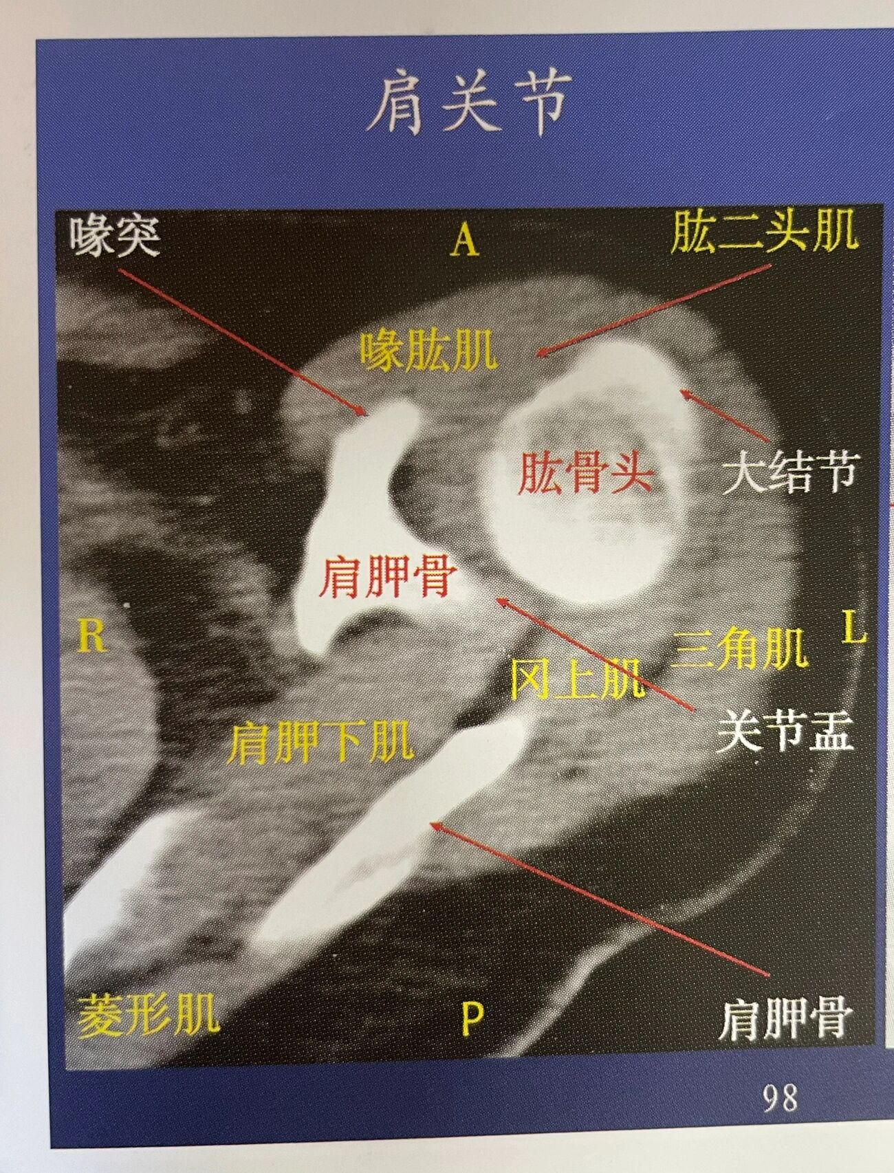ct之肩关节横断面解剖 肩关节是人体结构中最复杂,活动度最大的球窝