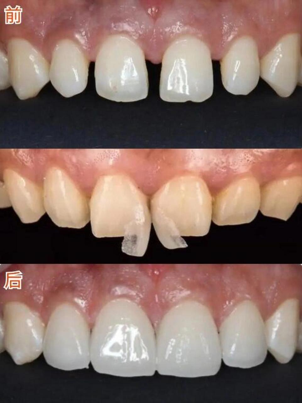 本身的牙齿比较直,没有存在外翻的情况,可以直接做到不磨牙粘贴. .