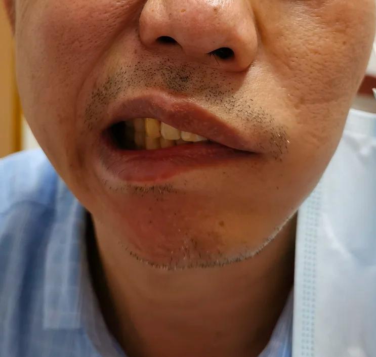 嘴歪不是病,而是一个症状,主要表现为口角歪斜
