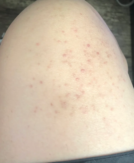 毛囊炎通常是金黄色葡萄球菌感染毛囊引起的