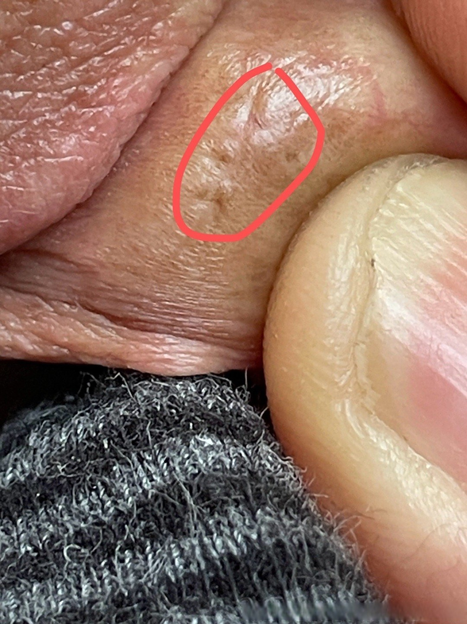 男男,31岁,2021年2月份的是冠状处有发现过尖锐湿疣并做了激光,后来