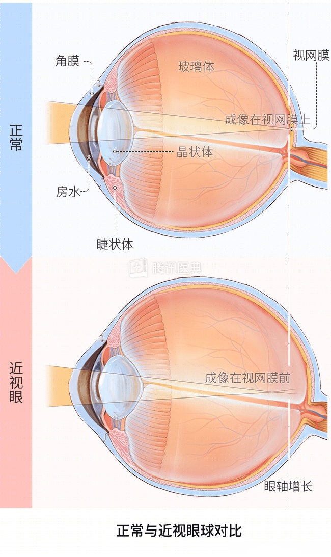 什么样子图片近视眼晶状体的变化近视眼晶状体近视眼球变化图近视图像