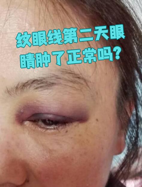 纹眼线后第二天眼睛肿是正常的,很多人都会这样