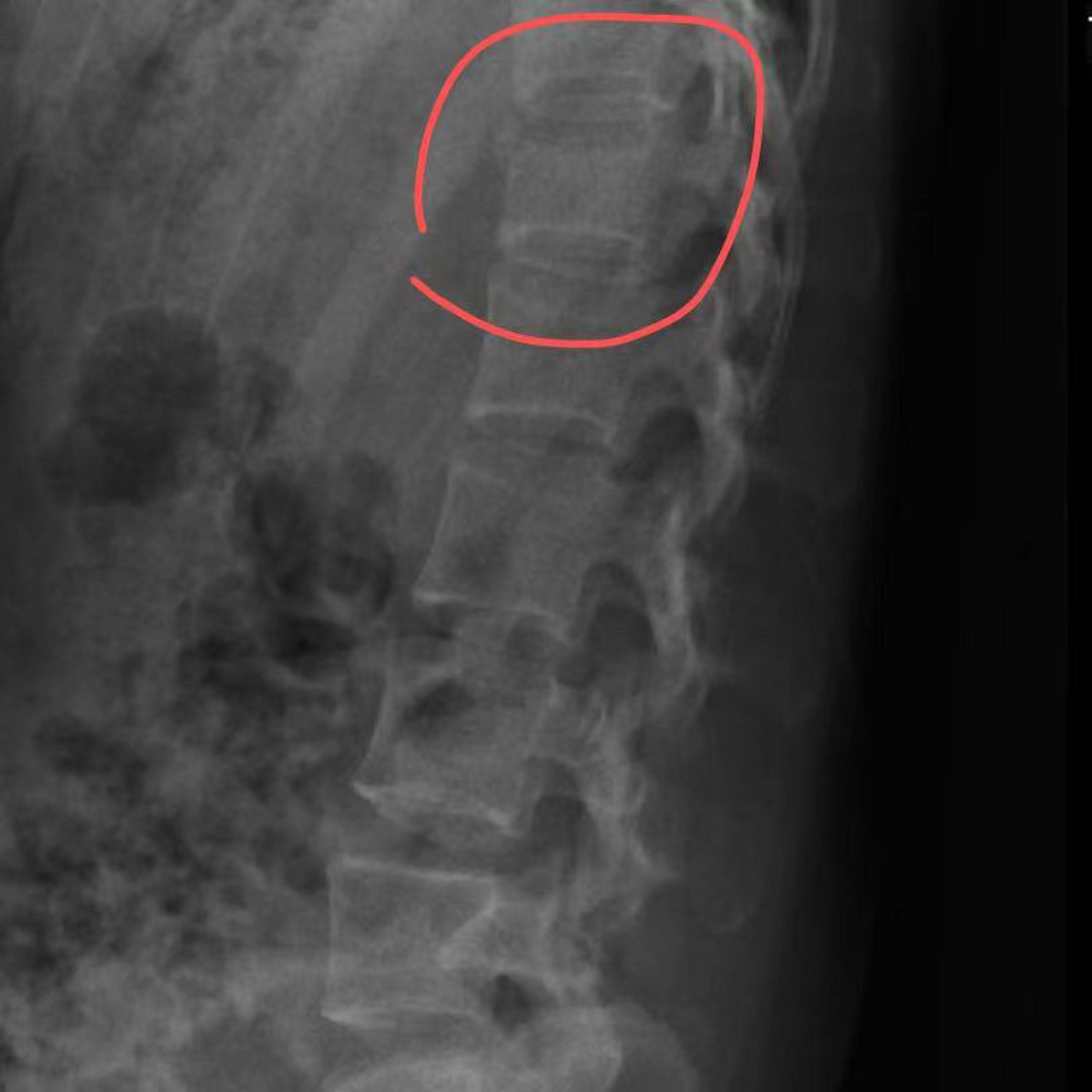 腰椎l1椎体压缩性骨折/绝卧第4天记录 一开始去医院看急诊的时候完全