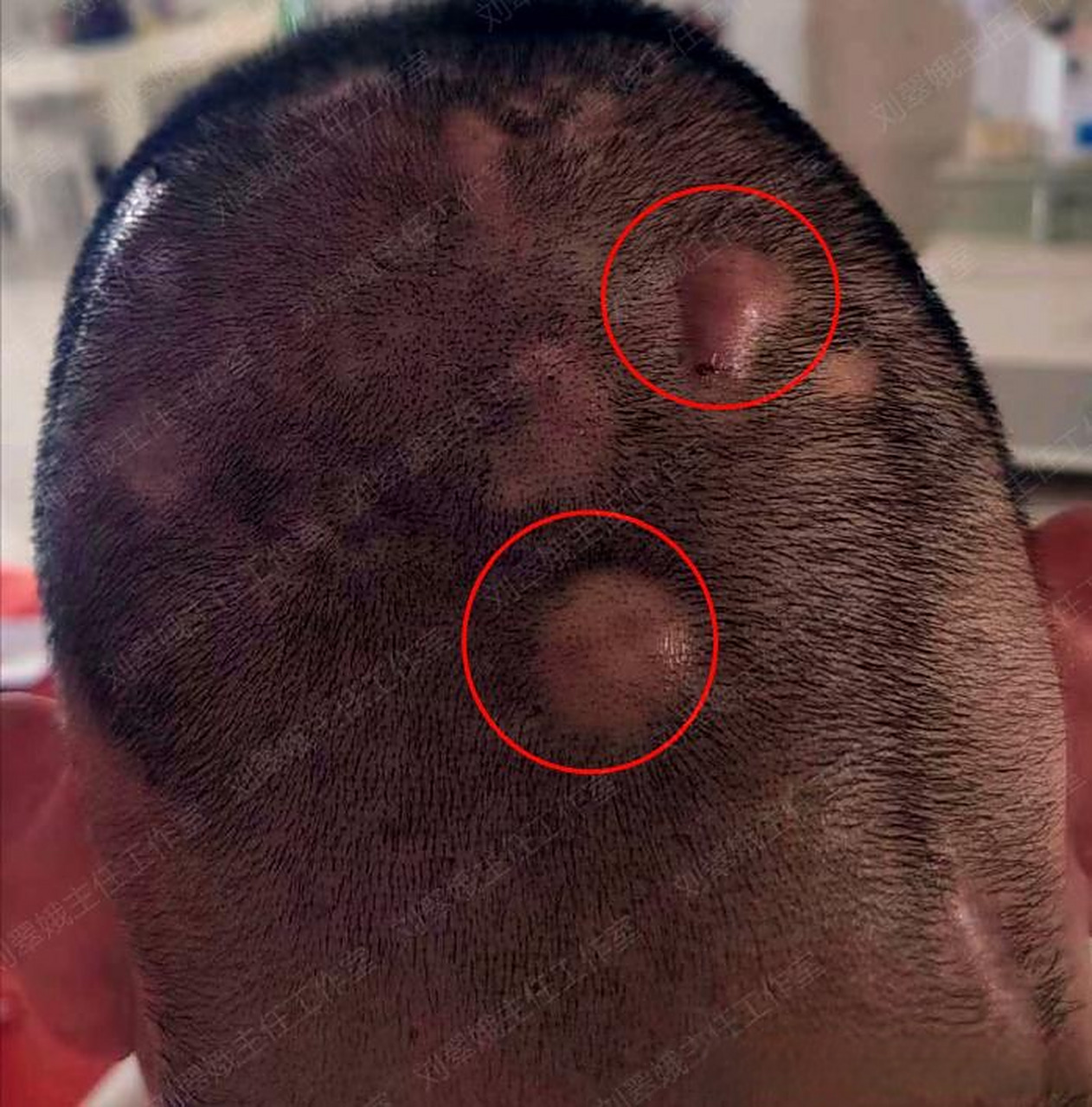 头皮长大脓包,中医解毒排脓,毛囊炎拿你没办法!