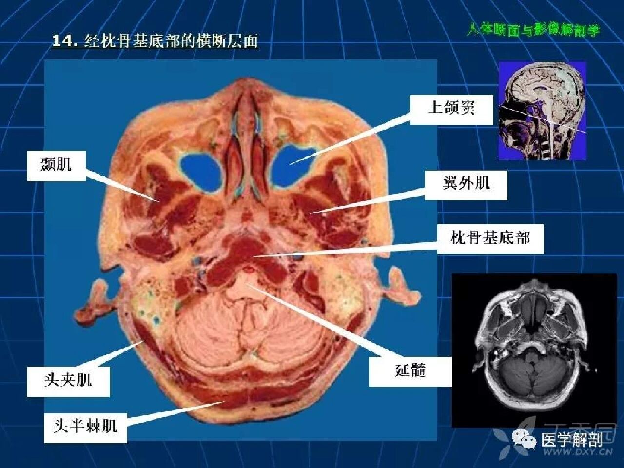 额窦解剖结构图图片