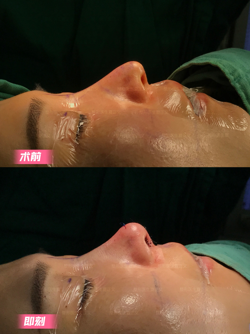 鼻子尖,鼻尖下旋,山根起点高,都会让鼻子显长,给人的亲和力不足.