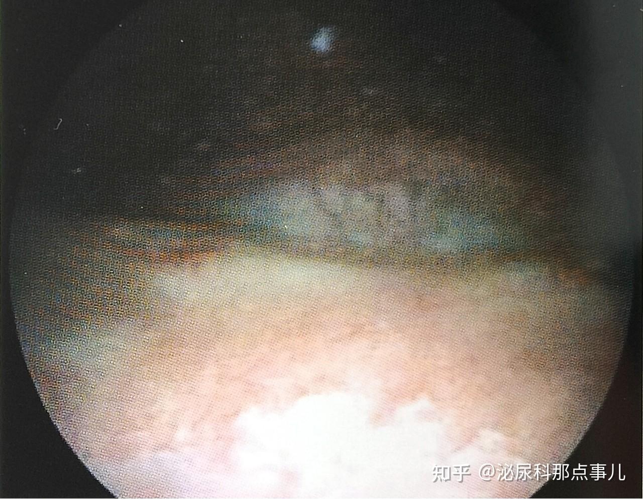 膀胱白斑图片