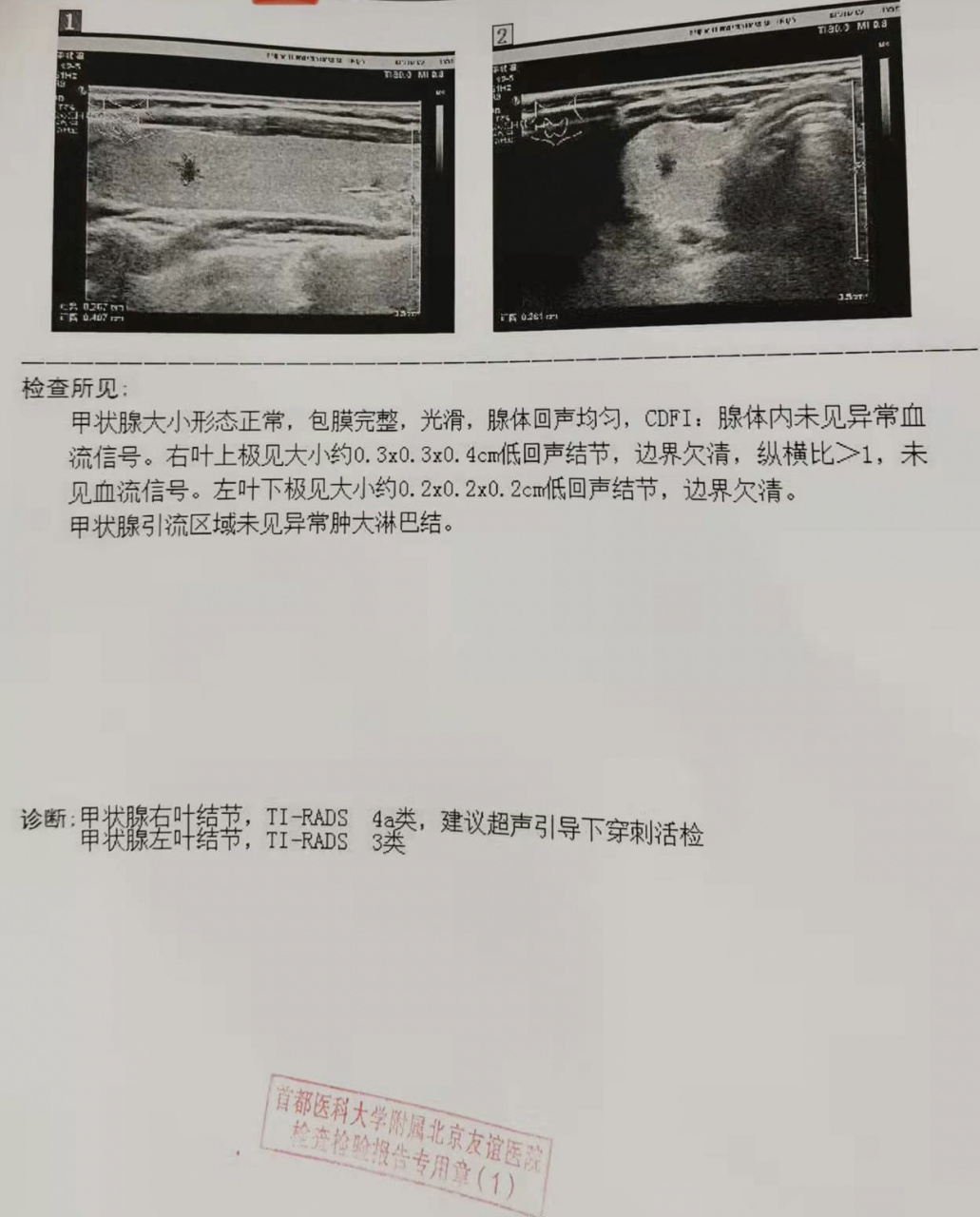 甲状腺结节,纵横比大于1不要怕,可能是良性 甲状腺结节已经好几年了