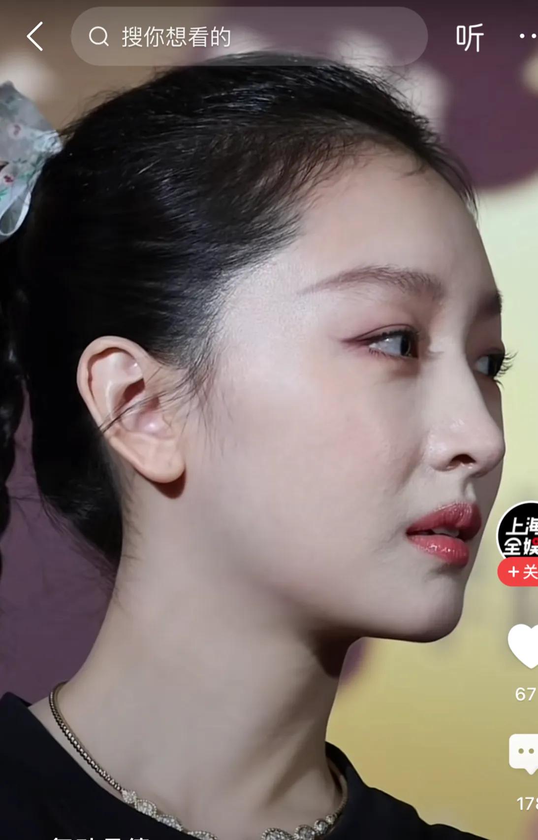 周冬雨应该是割了双眼皮加开眼角,对比山楂树之恋时期就可以看出,五官