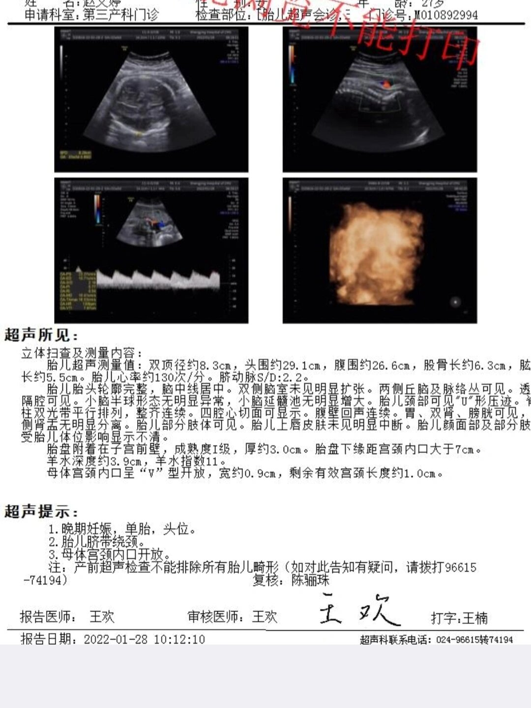 羊膜囊突入宫颈管图片