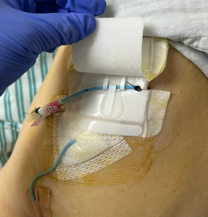 放置胸腔引流管时要注意三点:固定好管子,保持管