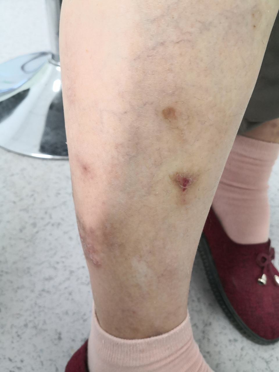 全身泛发红斑丘疹结节斑块症状.