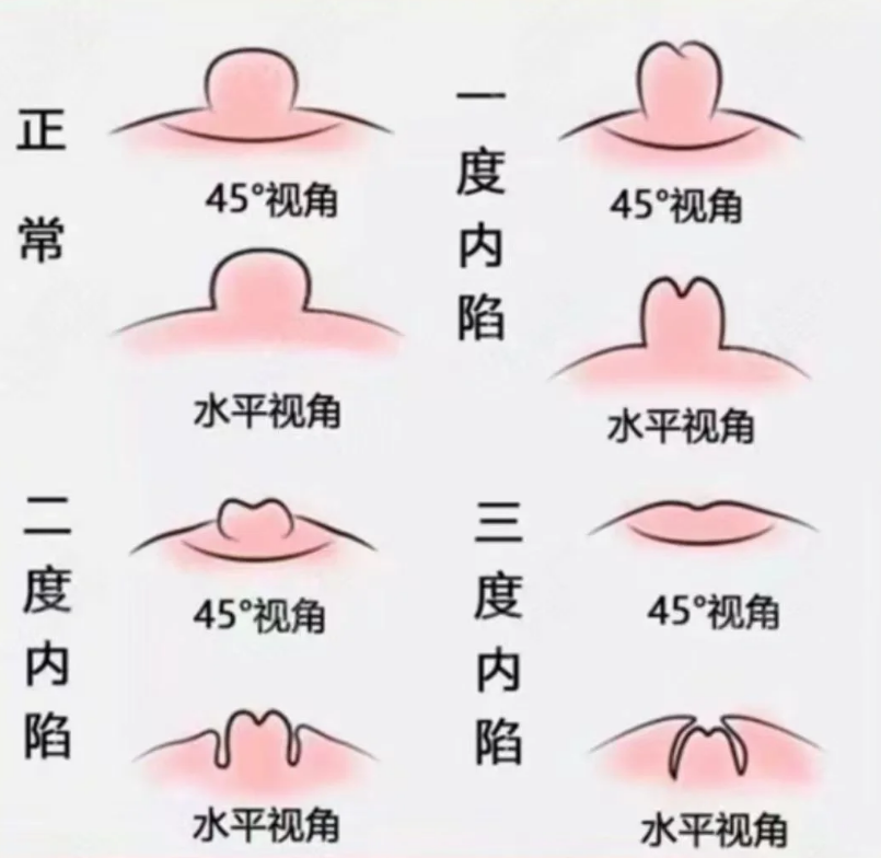 成年女性乳头小也可能是发育没完成,但怀孕和哺乳时乳头通常会再