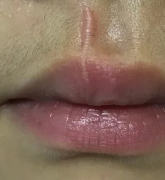 嘴唇缝针会不会留疤要看伤口情况.如果有问题,要马上去医院