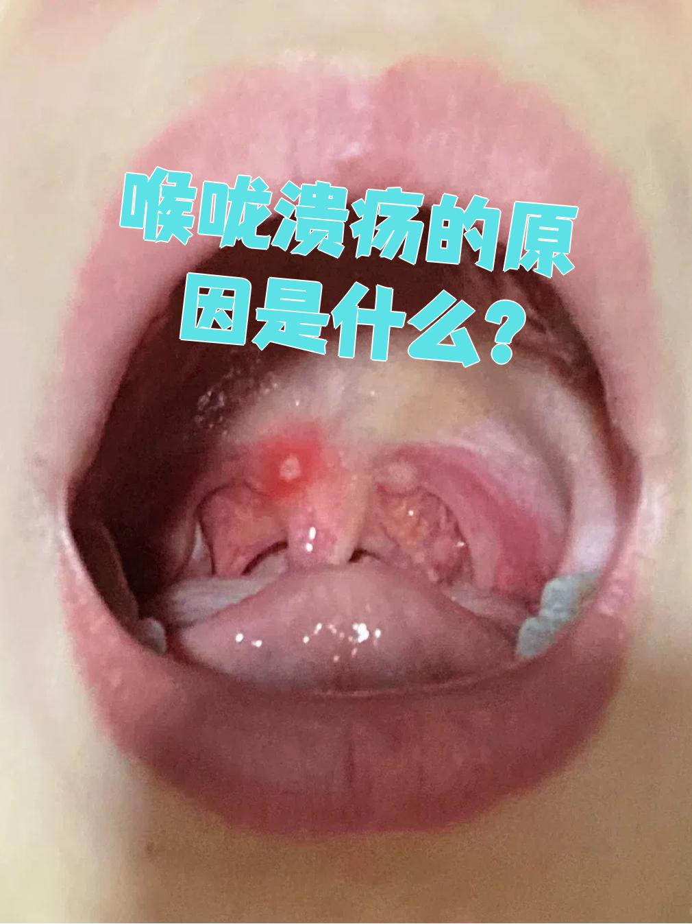 疱疹性咽峡炎,慢性扁桃体炎,慢性咽炎和咽喉恶性肿瘤等