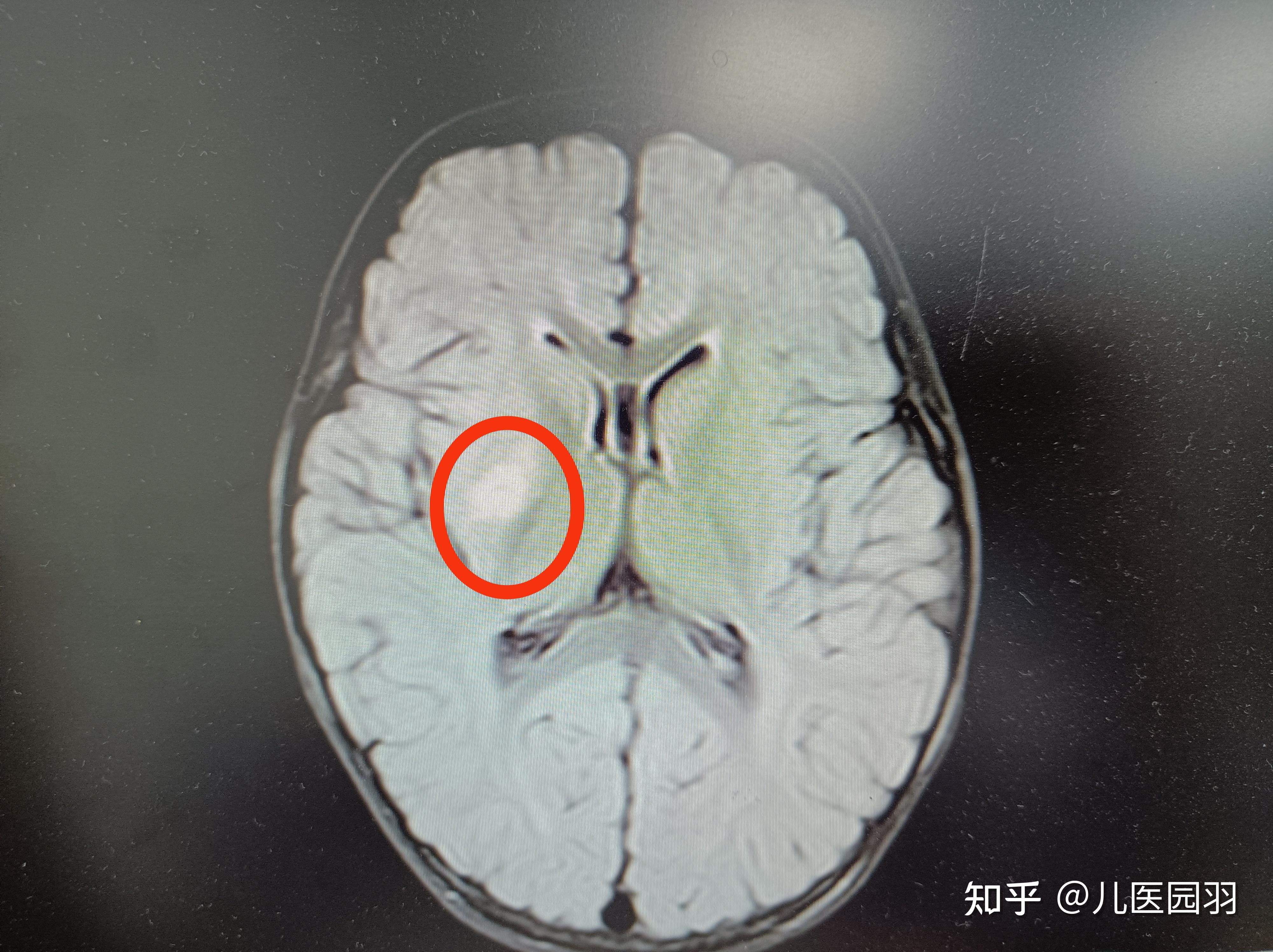 1岁半的孩子家中摔倒头颅磁共振提示脑梗死