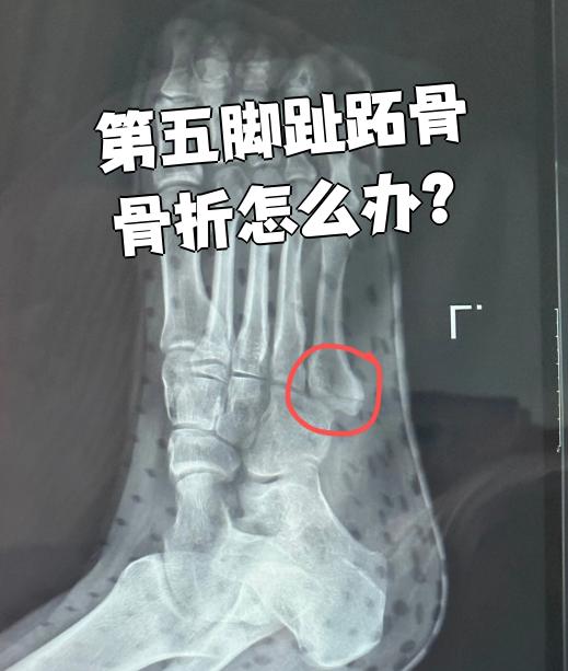 第五脚趾跖骨骨折通常由外伤引起,需要尽快去医院检查