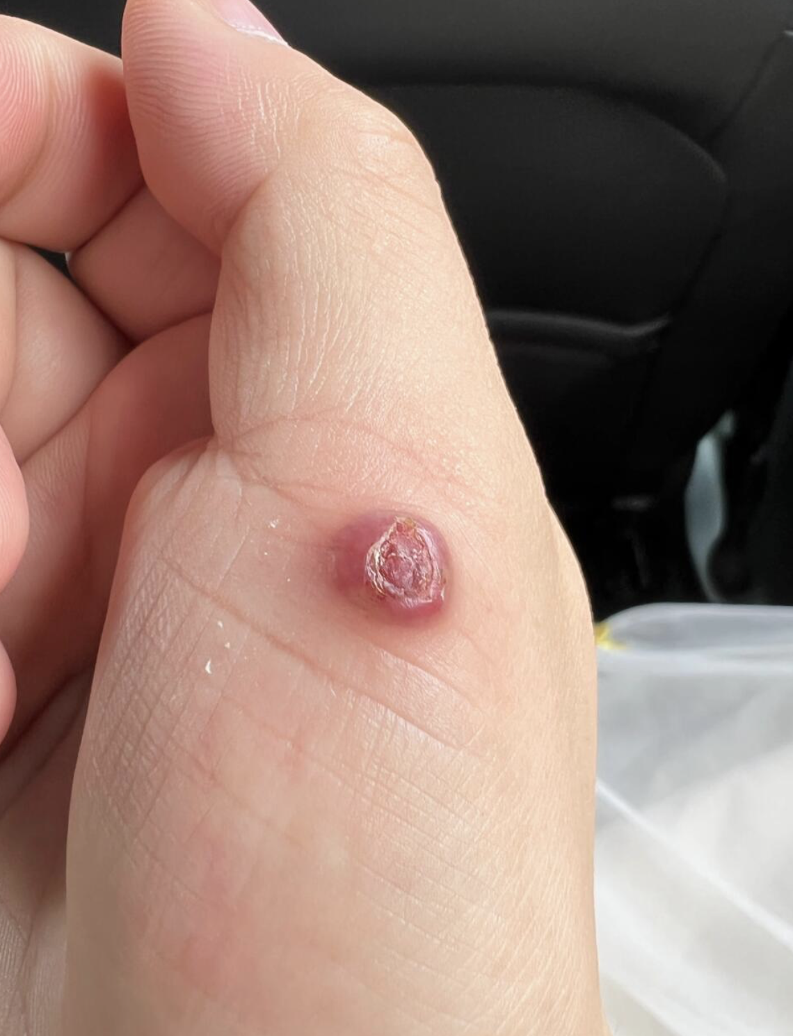 手指上出现红色小包并且有压痛感,常见原因包括炎性肿块和毛囊炎