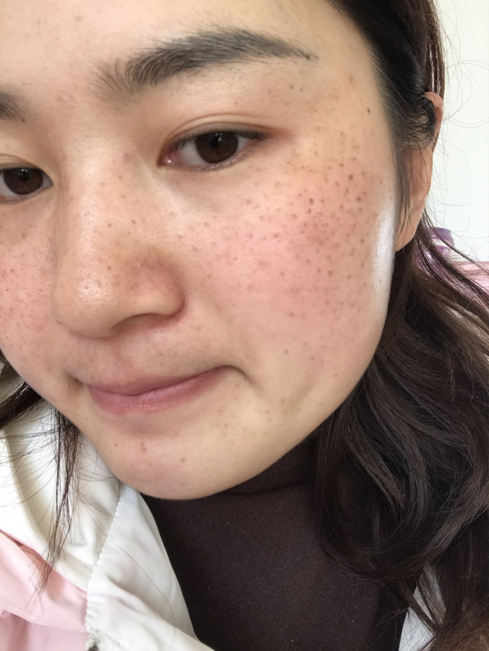 拯救一下我的麻子脸 从小就有,长大后越来越严重,怀过孕之后就更加