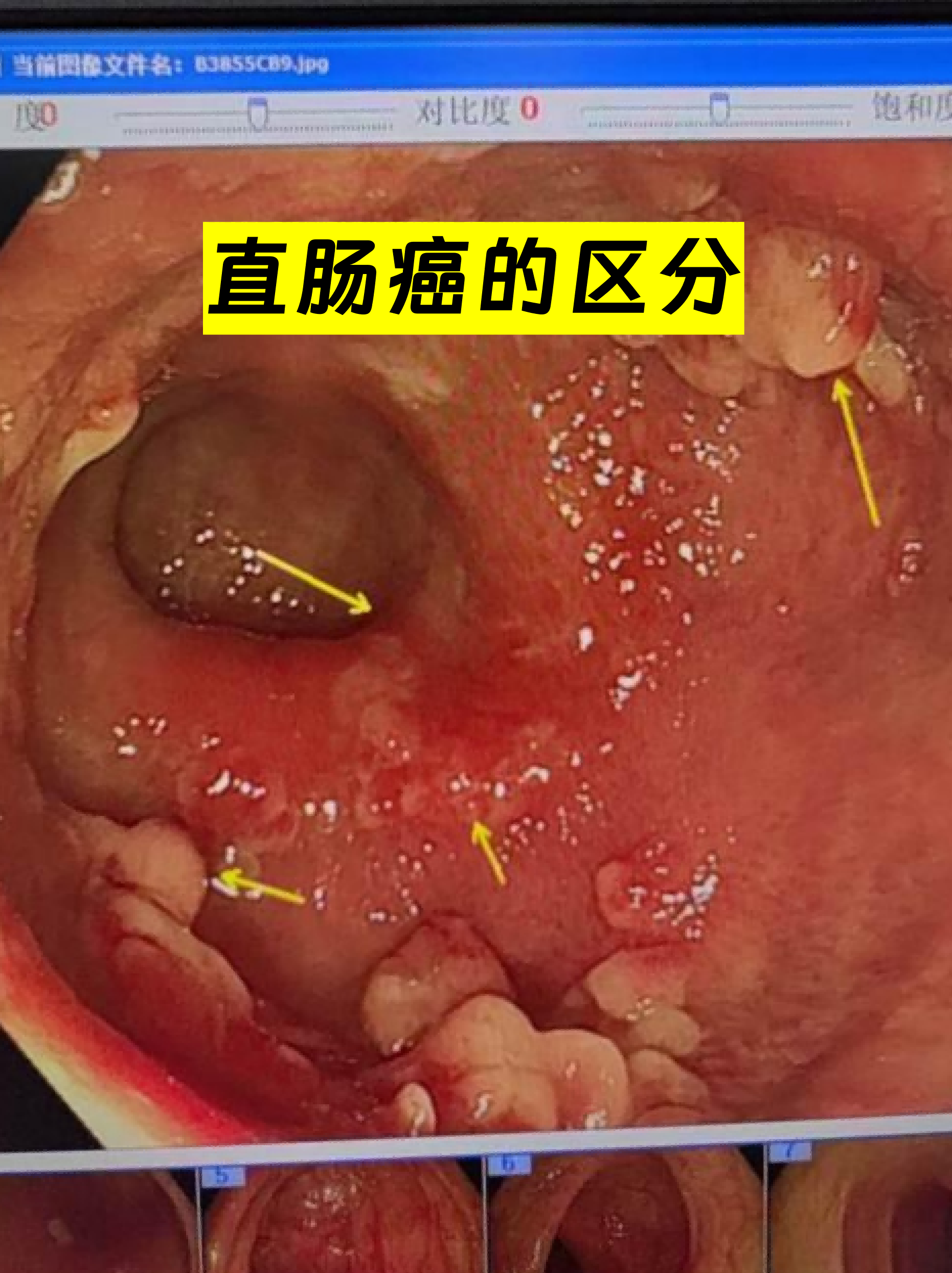 直肠癌的区分,主要从症状,检查手段