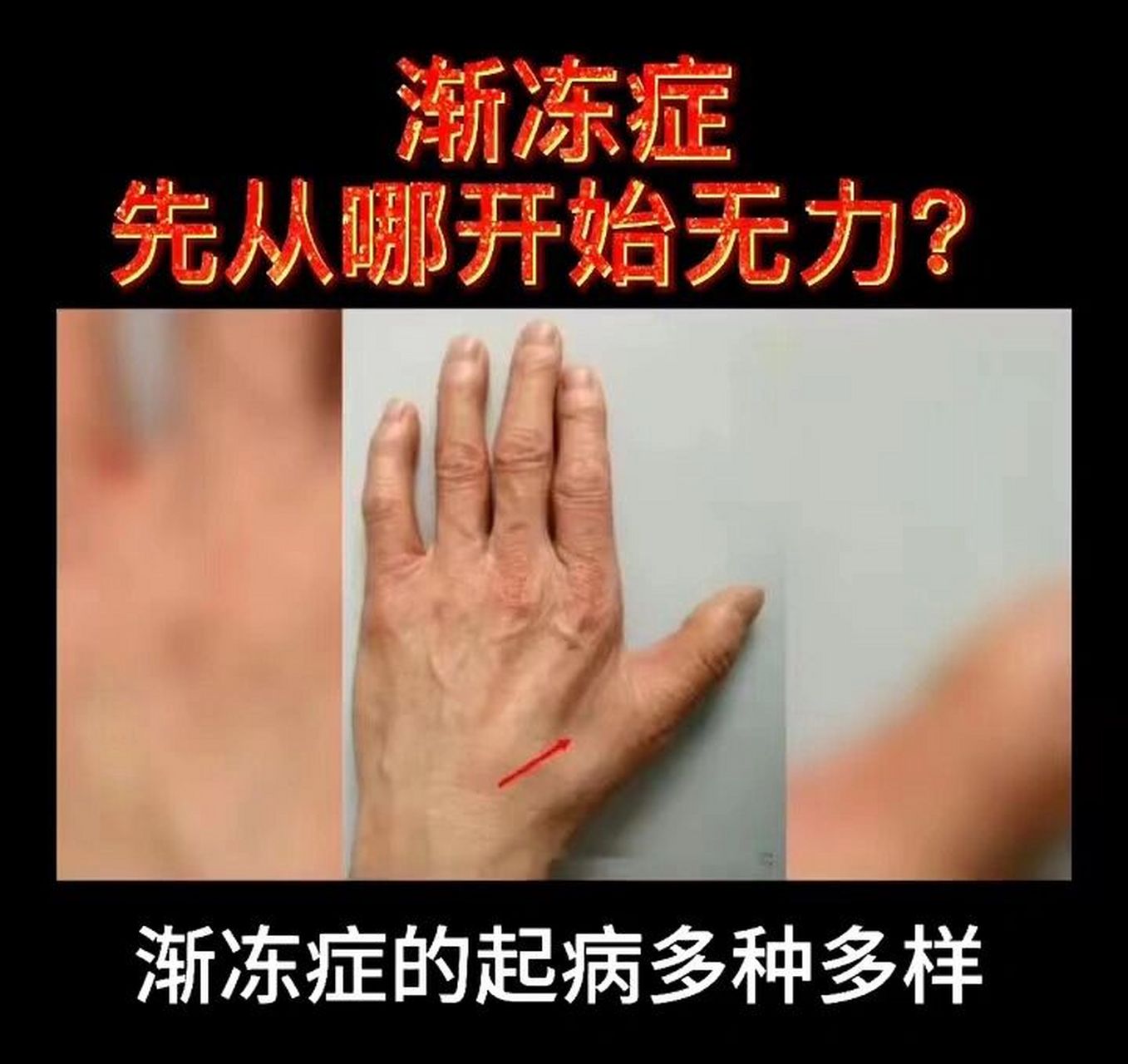 渐冻症是从哪里开始无力的?