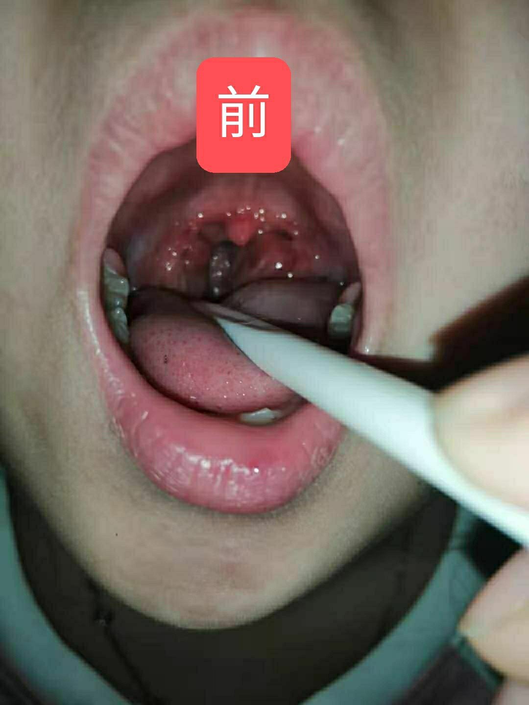 喉咙正常图片 对比图片