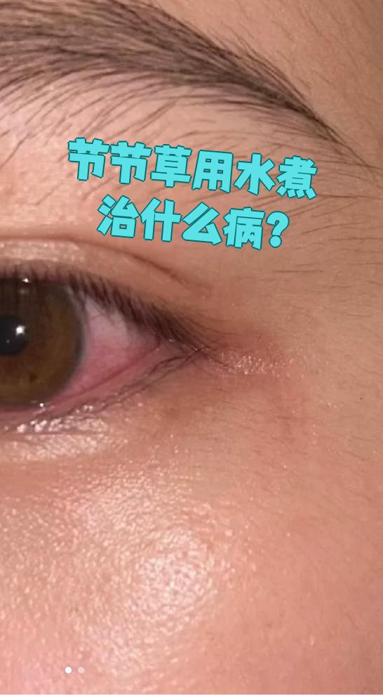 节节草用水煮可以治疗目赤肿痛,角膜云翳,肝炎和咳嗽这些病