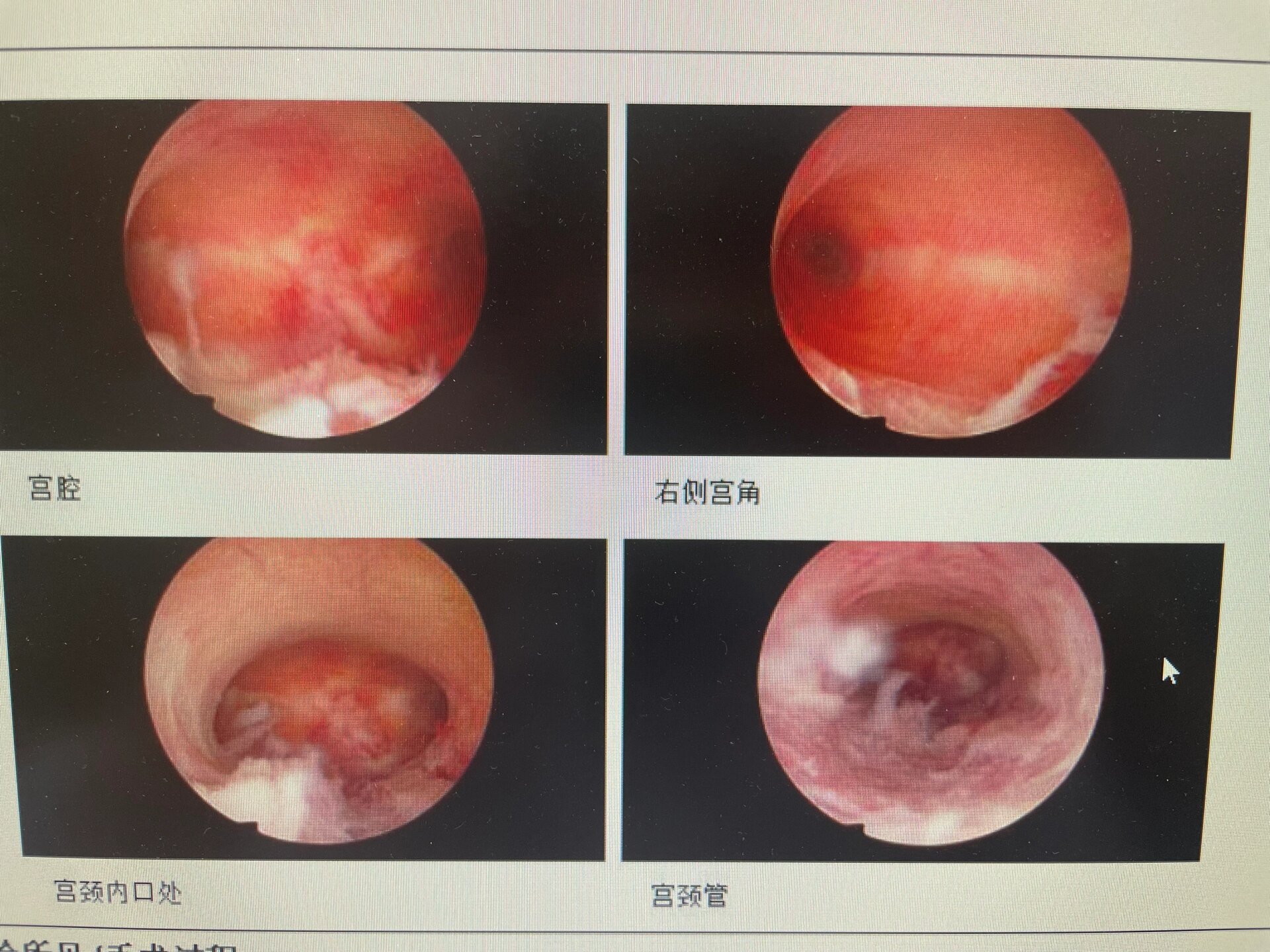 不全纵隔子宫y型图片图片