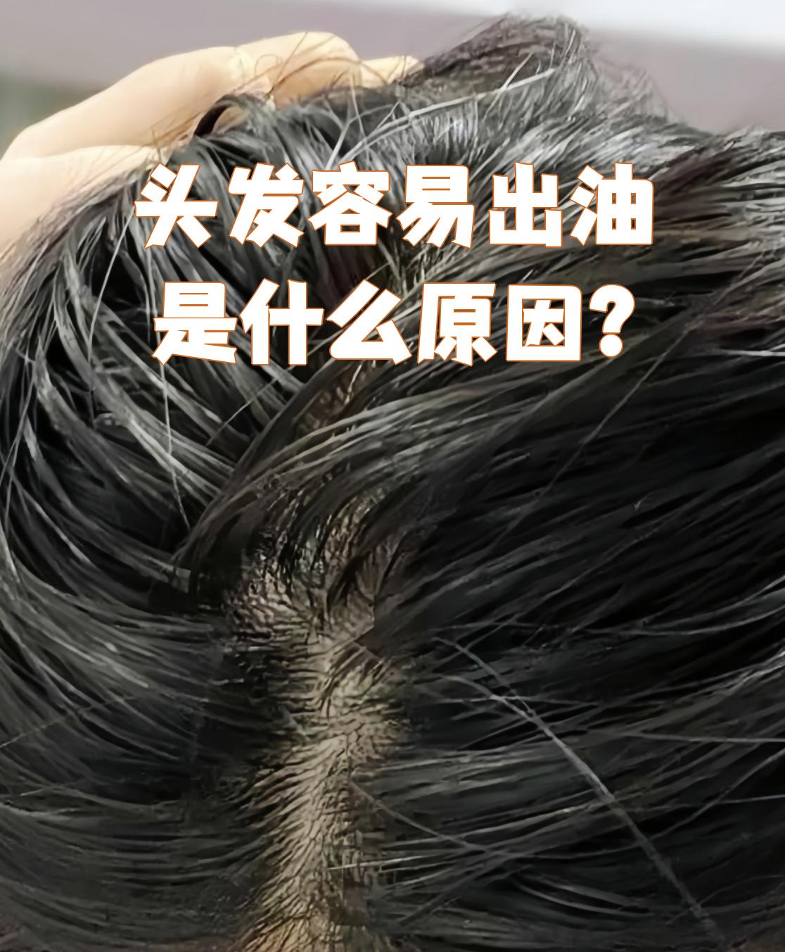 为什么头发总是很油