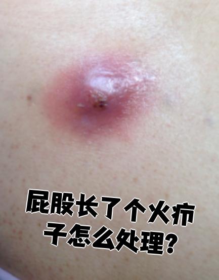 屁股上长了火疖子可以这样处理: