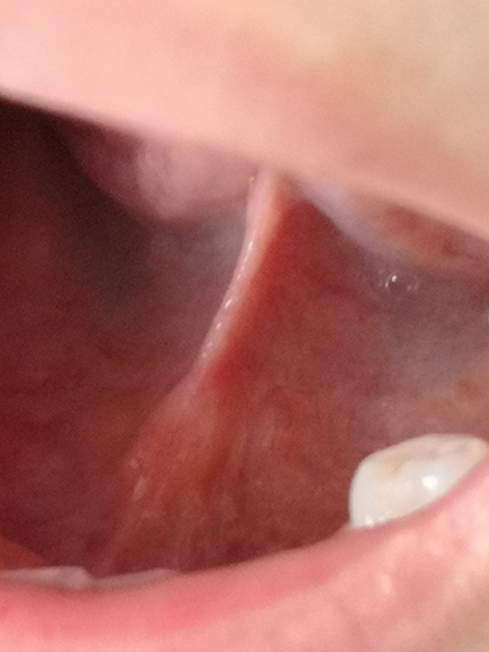 舌系带一侧边缘的丘疹结节.避免光滑.考虑囊肿或者结节.