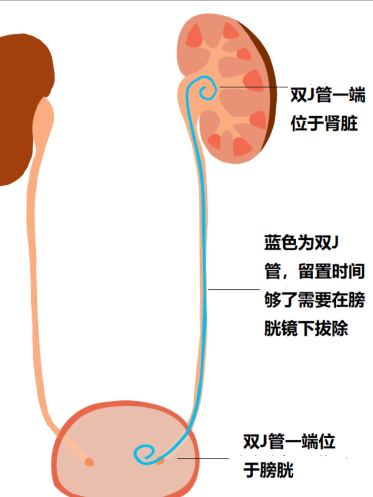 感觉自从放了双j管