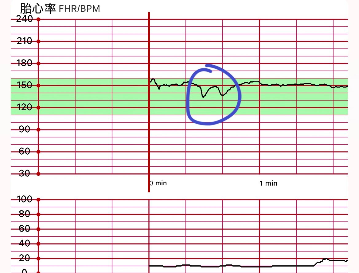 胎心监护变异减速图片