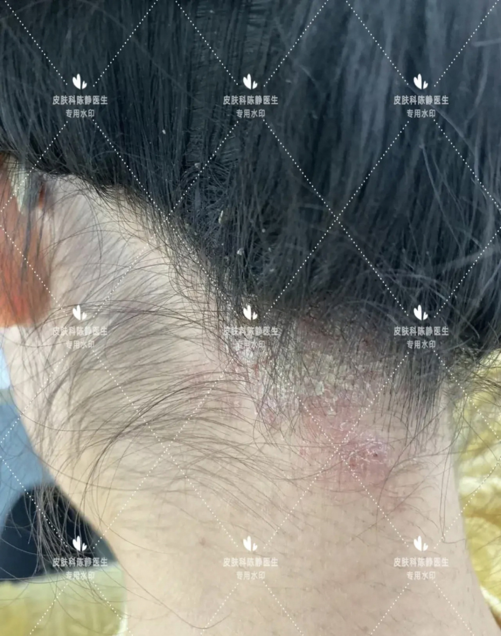 头皮脂溢性皮炎其实是一种疾病,最轻的就是大家熟知的头皮屑,头皮出现