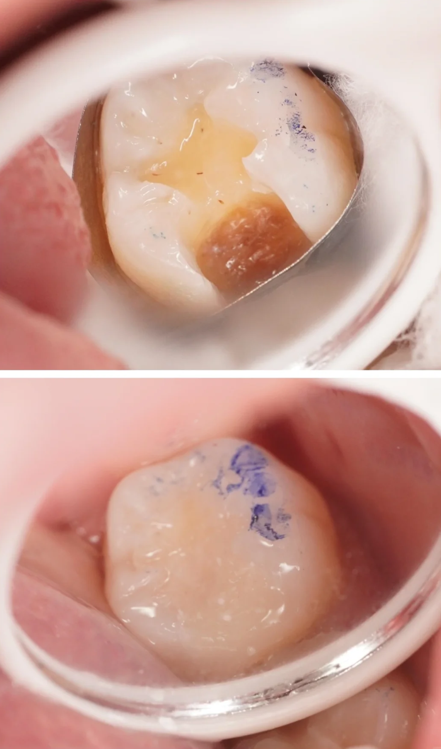 牙釉质受损后,根据损伤程度不同,主要有三种治疗方法