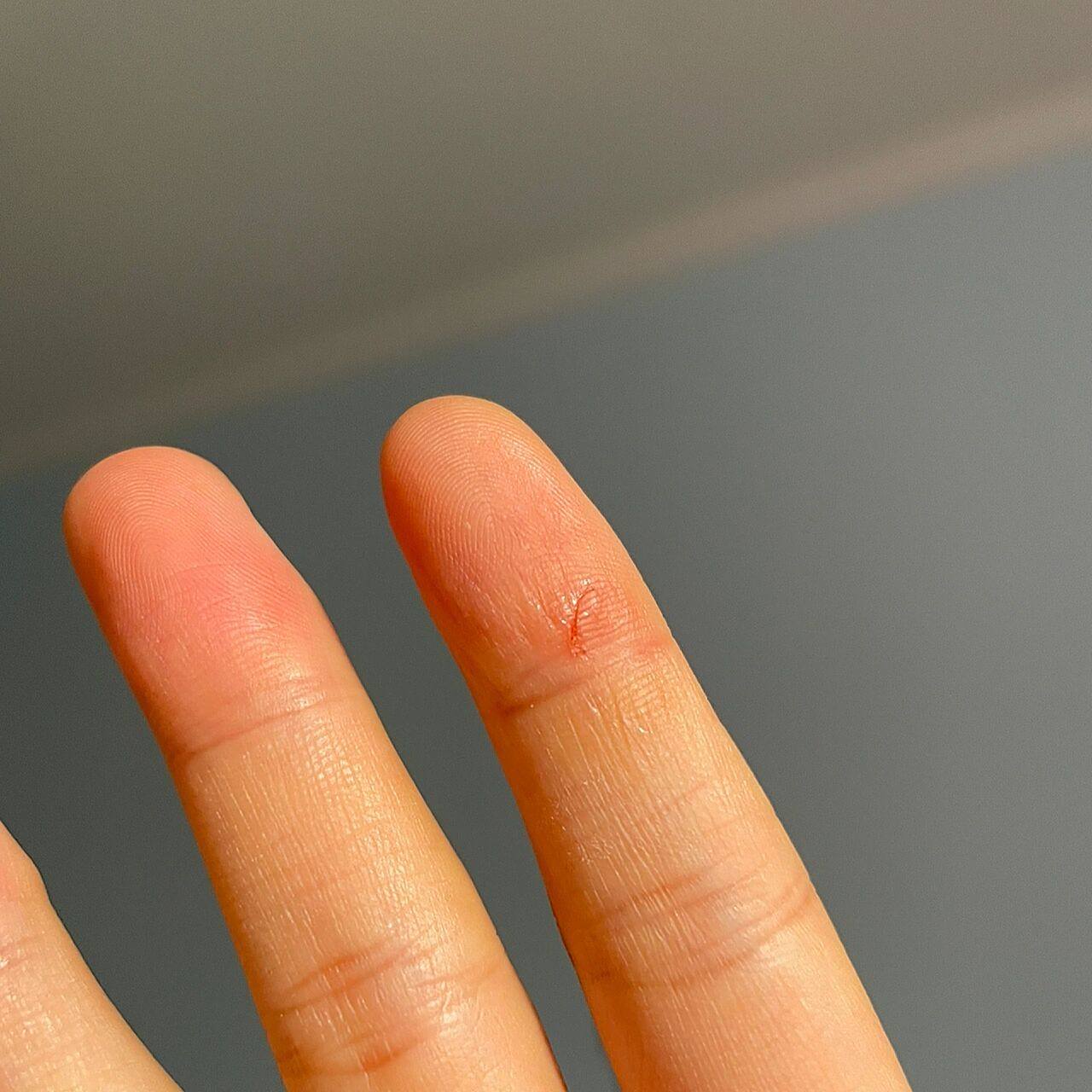 急6015被金丝熊咬出血00了要打疫苗吗?