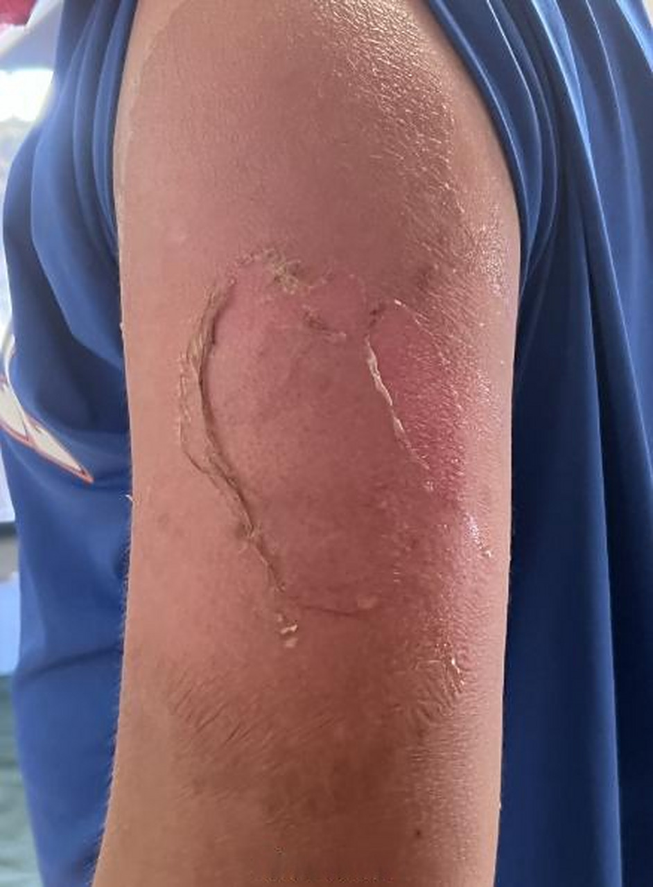 【长沙11岁男孩游泳2小时浅二度晒伤 】两只手臂发红发紫,长出水疱