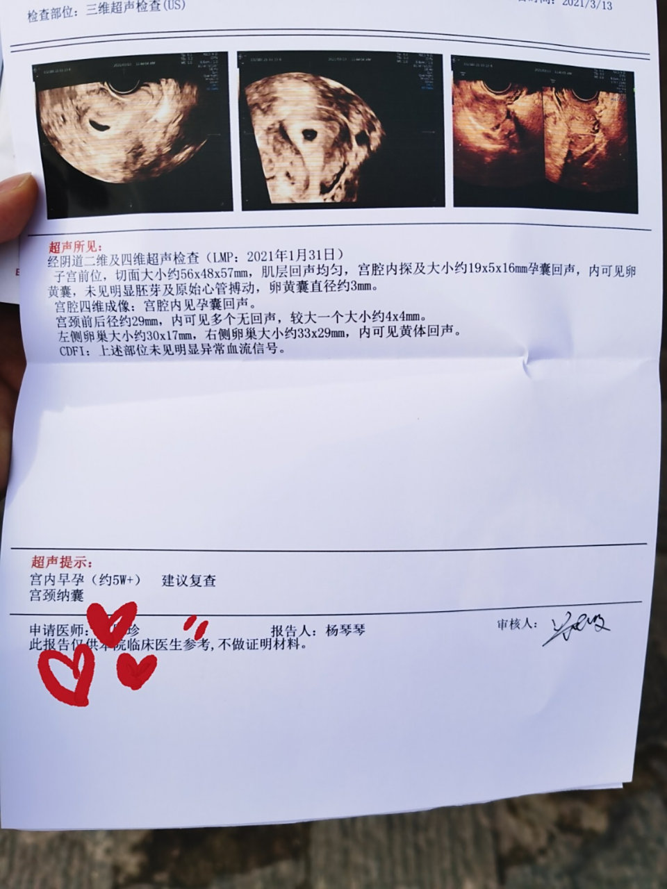 怀孕42天,排除宫外孕 今天b超看到孕囊,心里踏实下来了