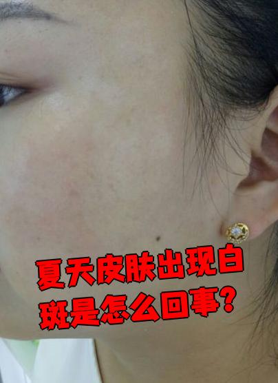 夏天皮肤突然长白斑,可能是这几种常见原因引起的: