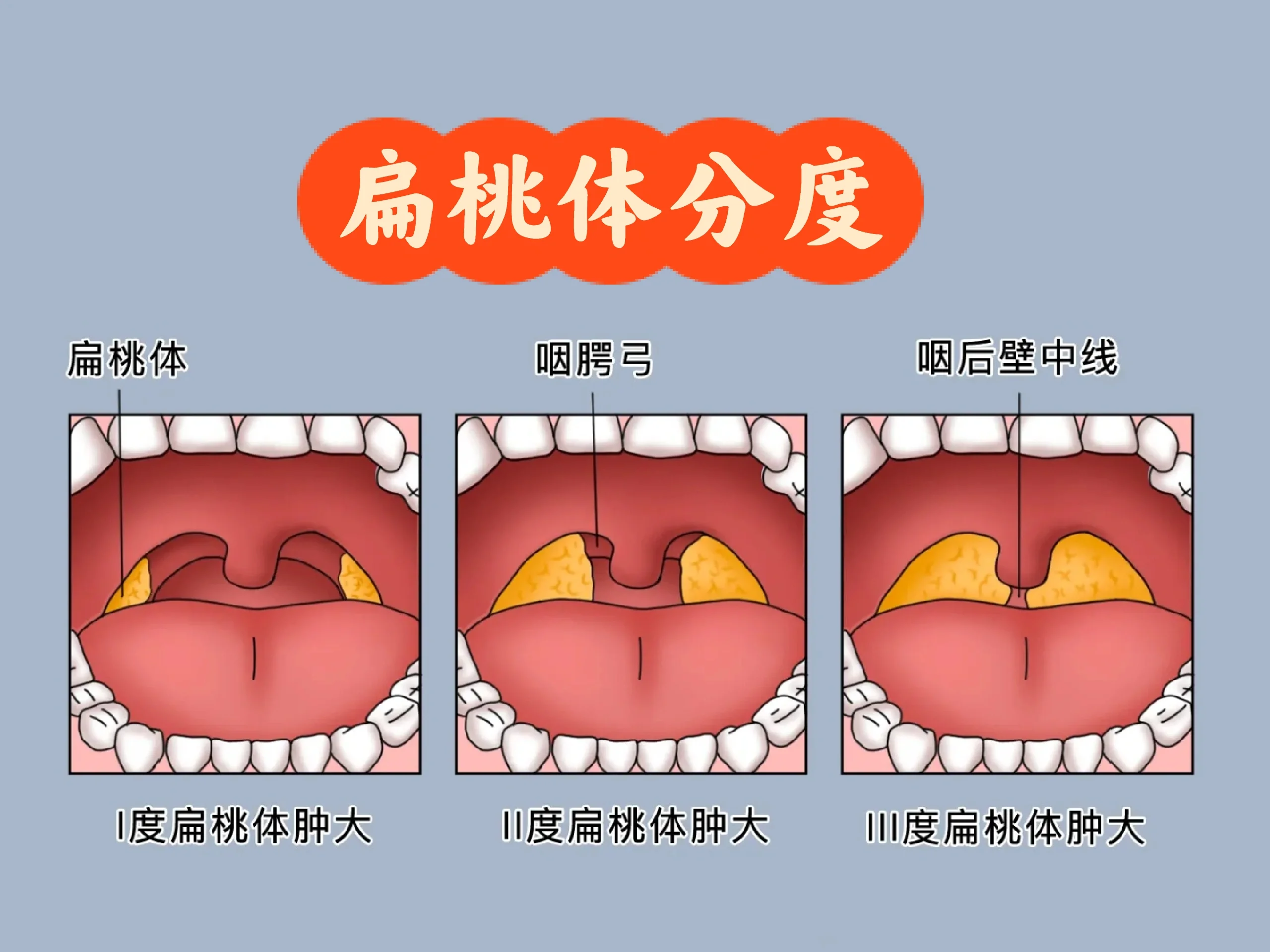 扁桃体分度图图片